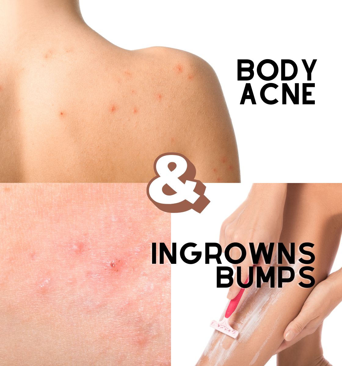 body Acne
