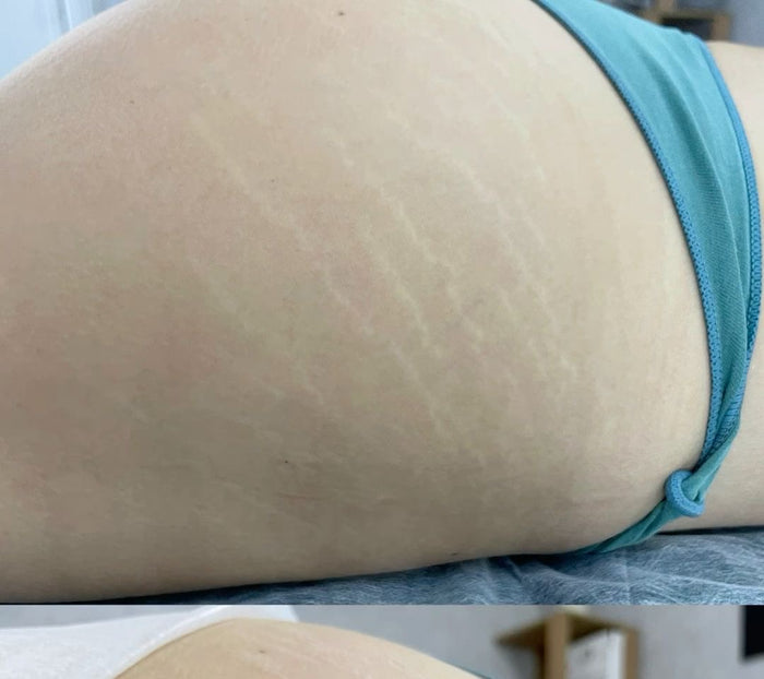 After — Stretch Mark & Repair kit Best Seller