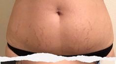Before — Stretch Marks Body Oil 30 ml