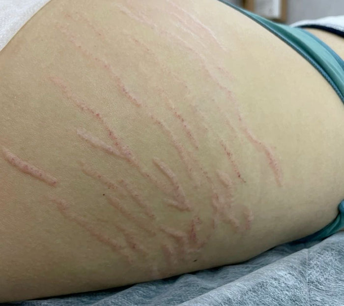 Before — Stretch Mark & Repair kit Best Seller