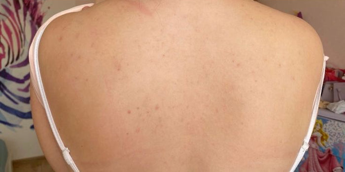 After — Citrus Blast Whipped Body Butter | AHA | Vitamin C Booster – SkinMush