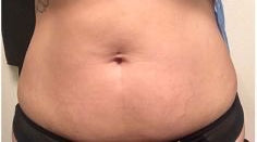 After — Stretch Marks Body Oil 30 ml