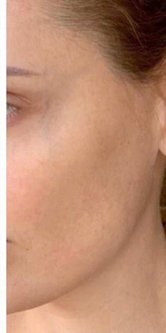 After — Skindae 3-in-1 Hybrid Sunscreen Gel SPF 50 | No White Cast | All Skin Types