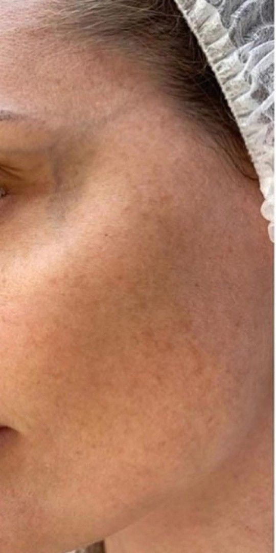 Before — Skindae 3-in-1 Hybrid Sunscreen Gel SPF 50 | No White Cast | All Skin Types