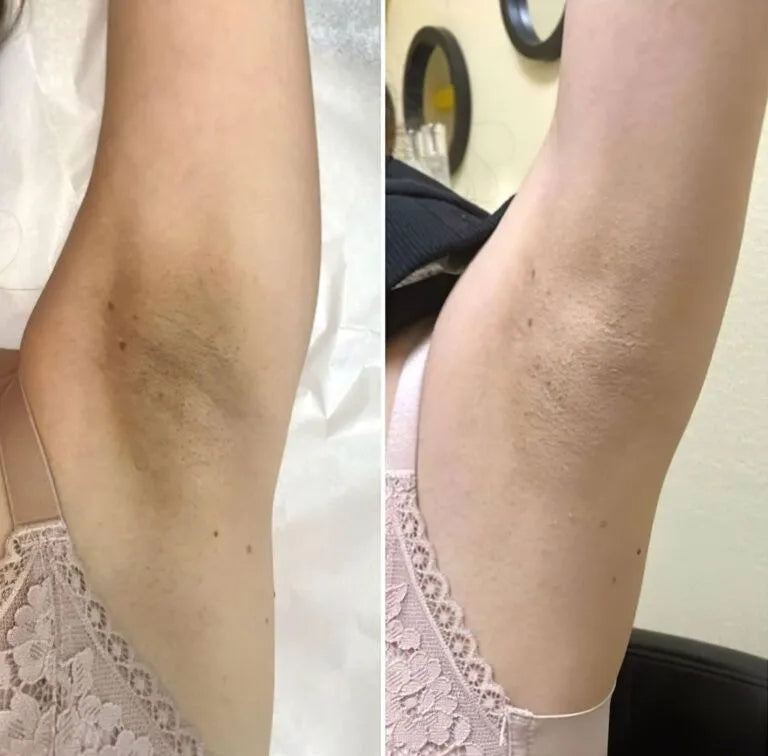 Comparison of leg hair before and after hair removal on a person wearing a white lace garment.